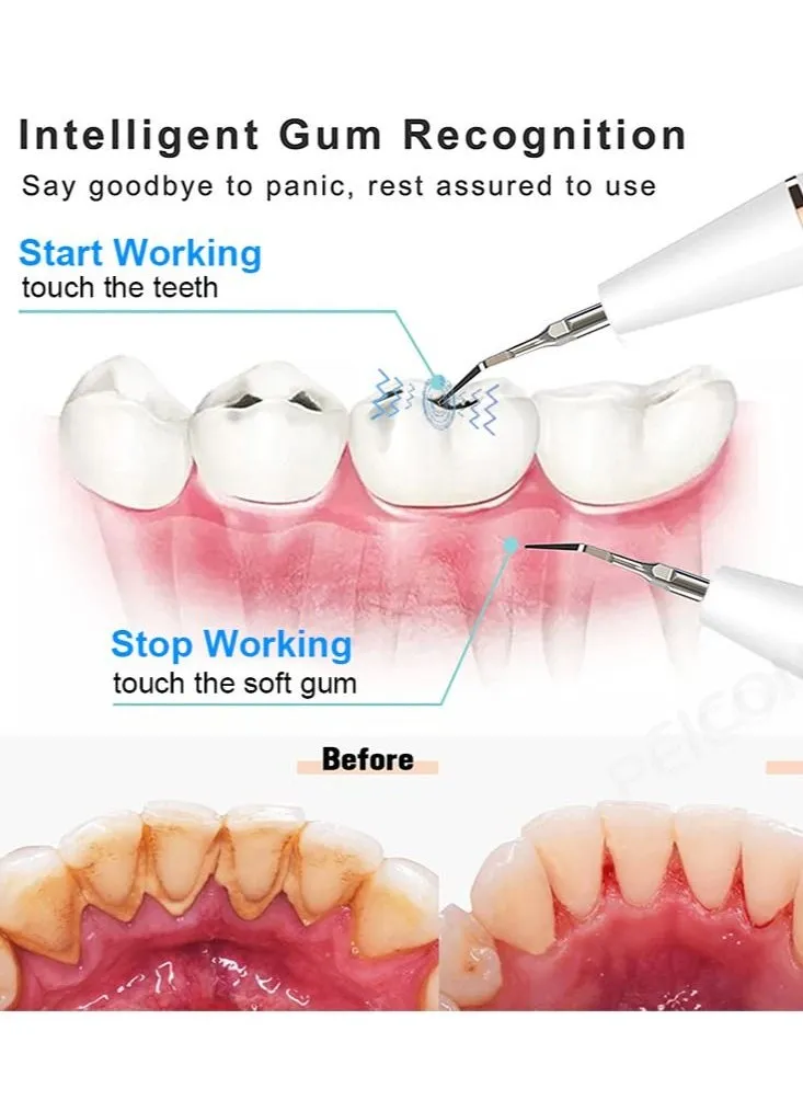 قشارة الأسنان بالموجات فوق الصوتية لإزالة بقع الأسنان ومزيل تكلس الأسنان الكهربائية ومنظف البلاك وإزالة أحجار الأسنان ورؤوس نظيفة قابلة للاستبدال - آمنة-2